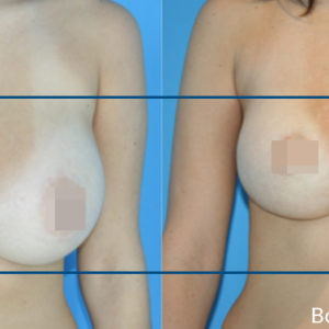 Liposukcja BodyTite Breast